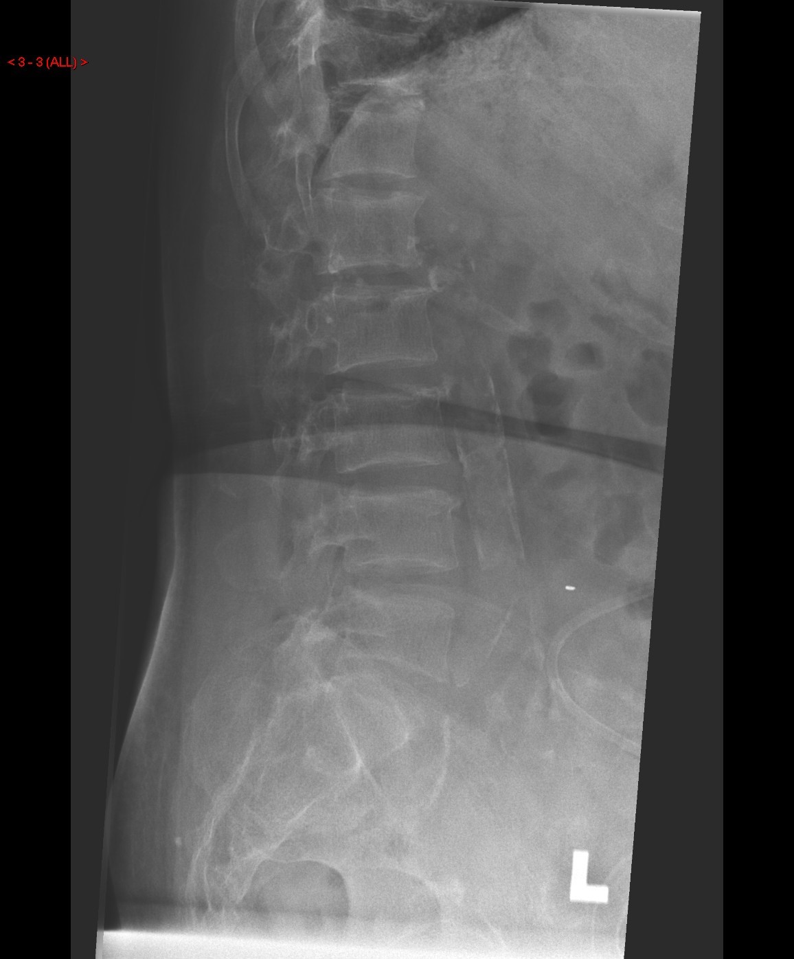 X Rays of lumbosacral spine 2